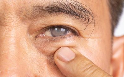 7 Cataract Myths That Could Put Your Vision at Risk